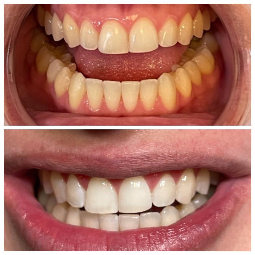 TEETH WHITENING – BRING A BUDDY $99 EACH!