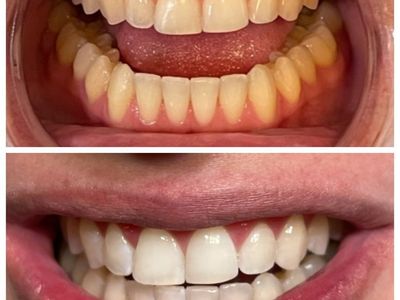 TEETH WHITENING – BRING A BUDDY $99 EACH!