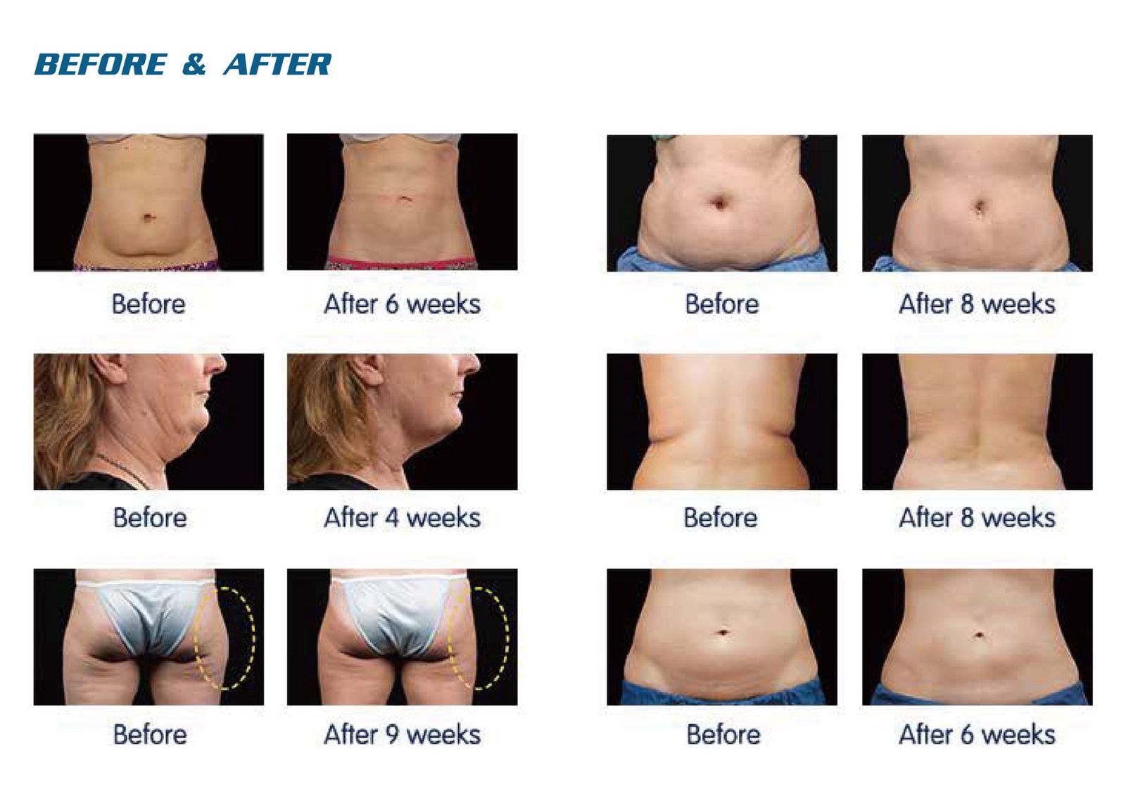 Professional Cryolipolysis Machine with 3 Handles & Gel Pads - Body Sculpting & Fat Freezing