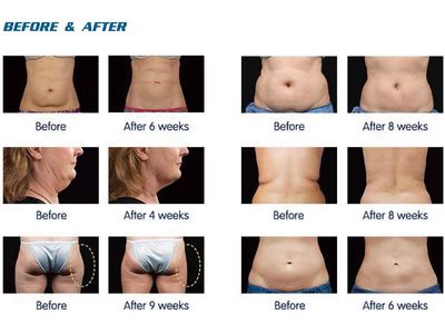Professional Cryolipolysis Machine with 3 Handles & Gel Pads - Body Sculpting & Fat Freezing