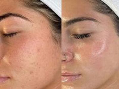 June Promo $50 Facial extractionn